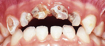 progression_tooth_decay4